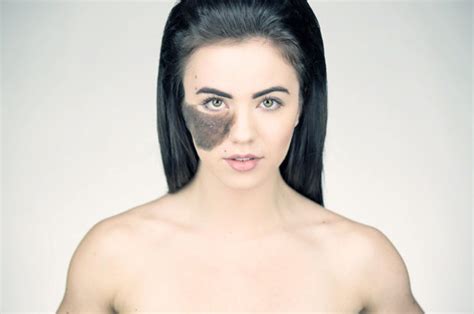 This Dancer Refused To Get A Hairy Birth Mark On Her Face.